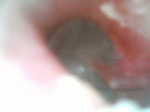 Just Took Some Pics of My Ear Drum and Here s What I Found Help