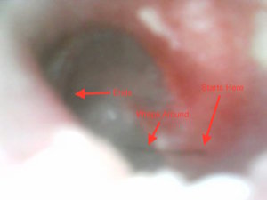 Just Took Some Pics of My Ear Drum and Here s What I Found Help