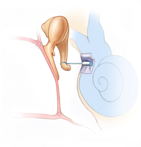 ossiculoplasty22.png