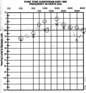 audiogram.png